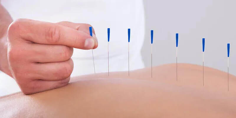 Scopri i Benefici dell'Agopuntura: Trattamenti Efficaci e Naturali